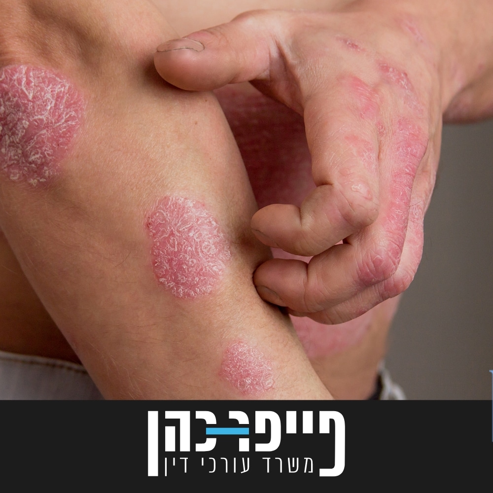 סעיף 80 - אקזמה כרונית