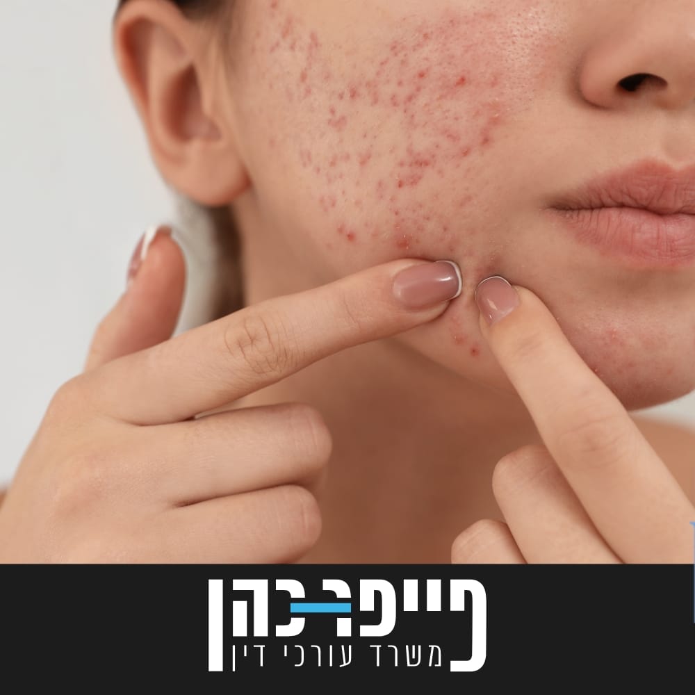 סעיף 79 - אקנה ולגריס