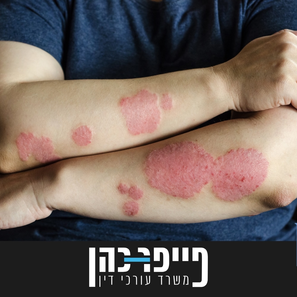 סעיף 87 - שחפת העור