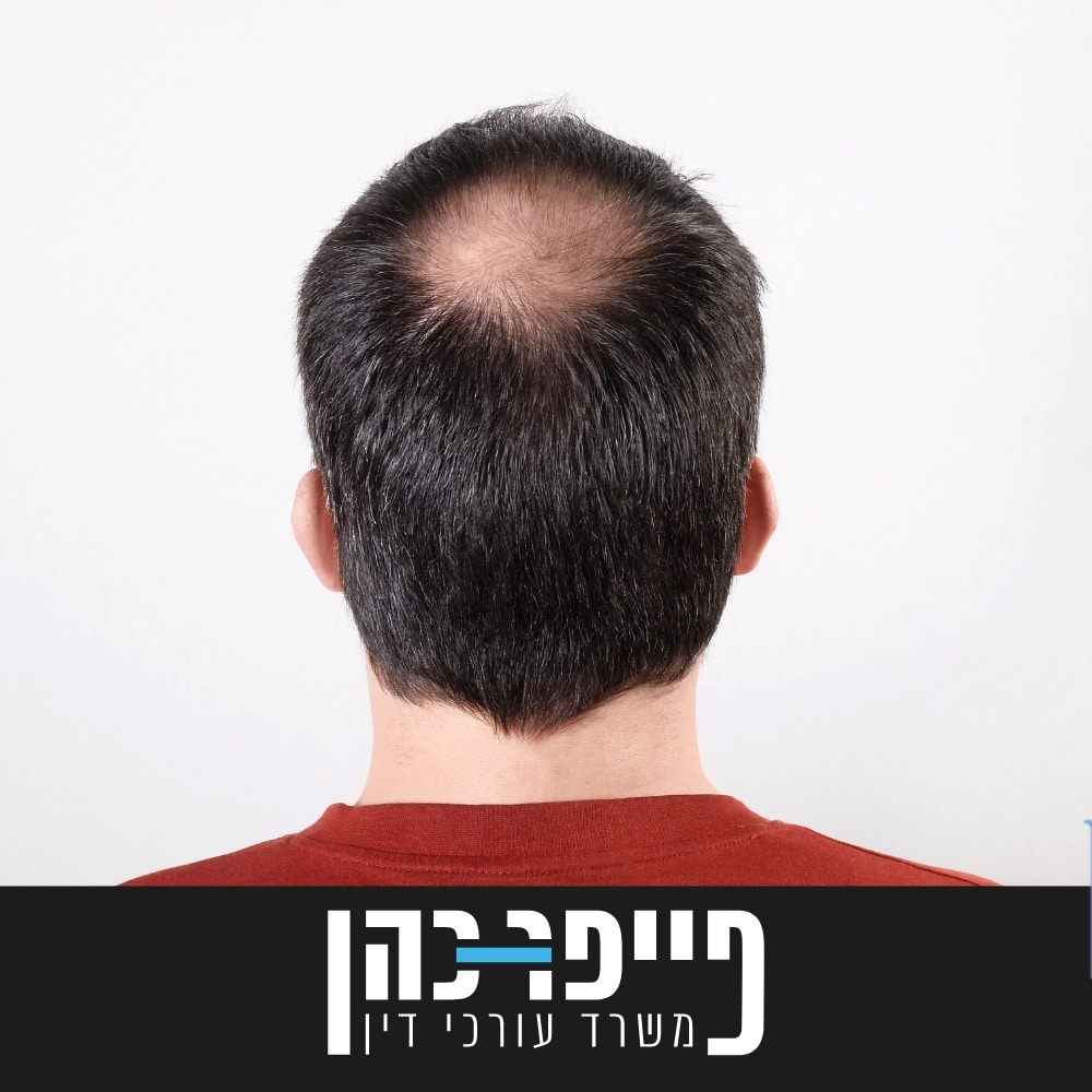 סעיף 77 - אלופציה אראטה אוניברסליס