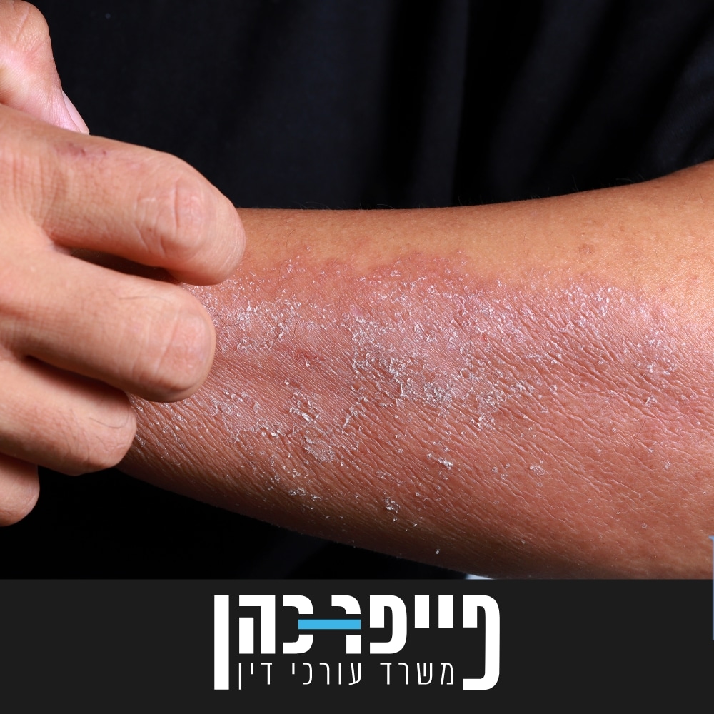 סעיף 85 - X RAY DERMATITIS