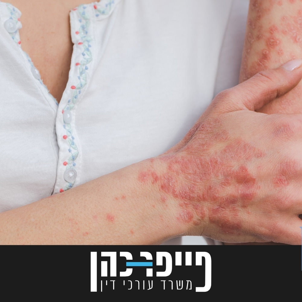 סעיף 84 - דלקת כרונית בעור, פסוריאזיס