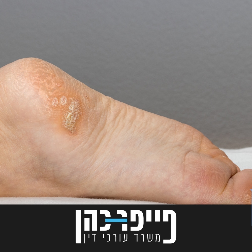 סעיף 82 - VERRUCAE PLANTARES - יבלות פלנטריות